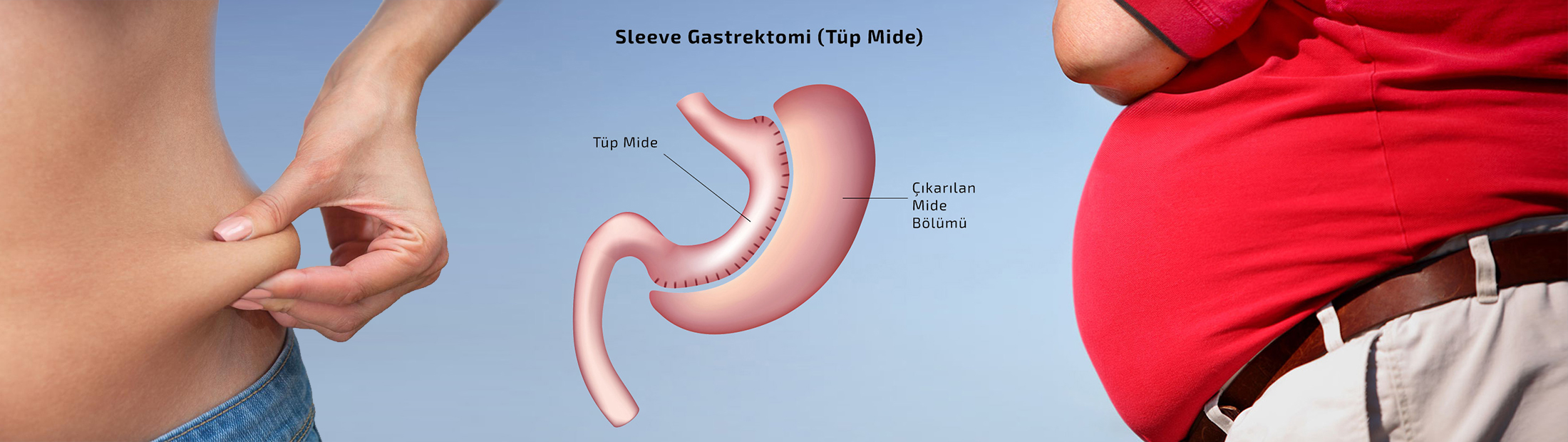 Gastric Sleeve Turkey: All-Inclusive Cost Breakdown for Weight Loss Success post thumbnail image
